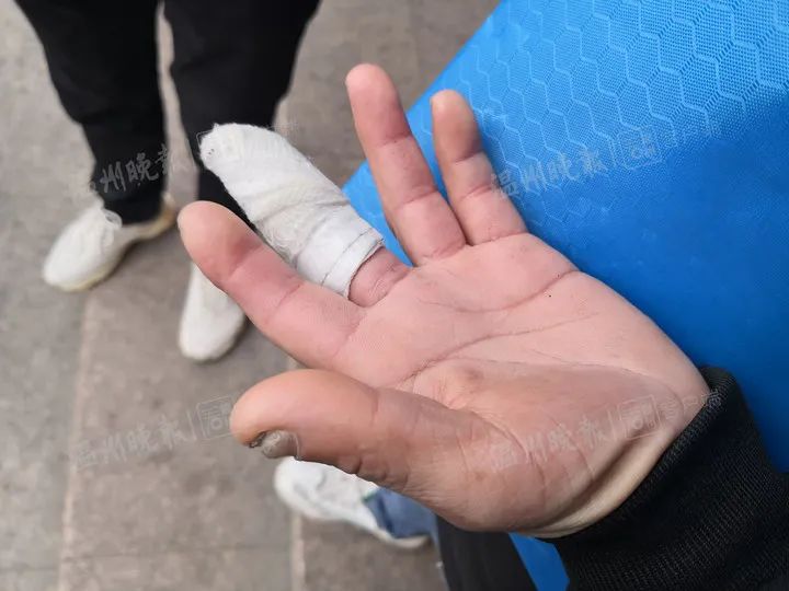 浙江一男子受伤，做完手术后短了一截？！医院回应了……