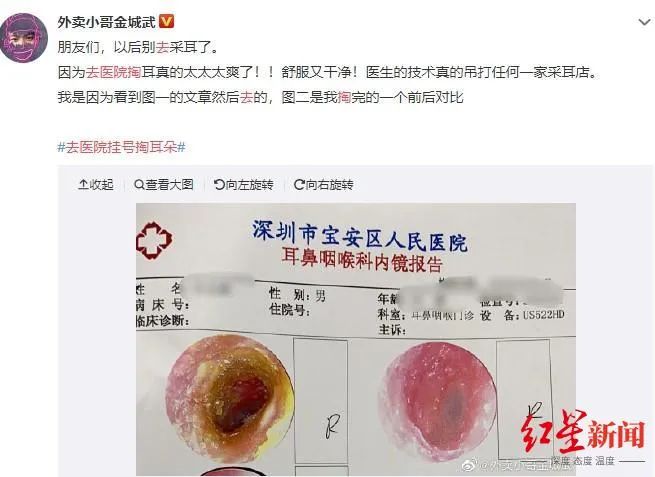 “去医院挂号掏耳朵”上热搜?医生:不稀奇,每天来掏耳朵的人很多