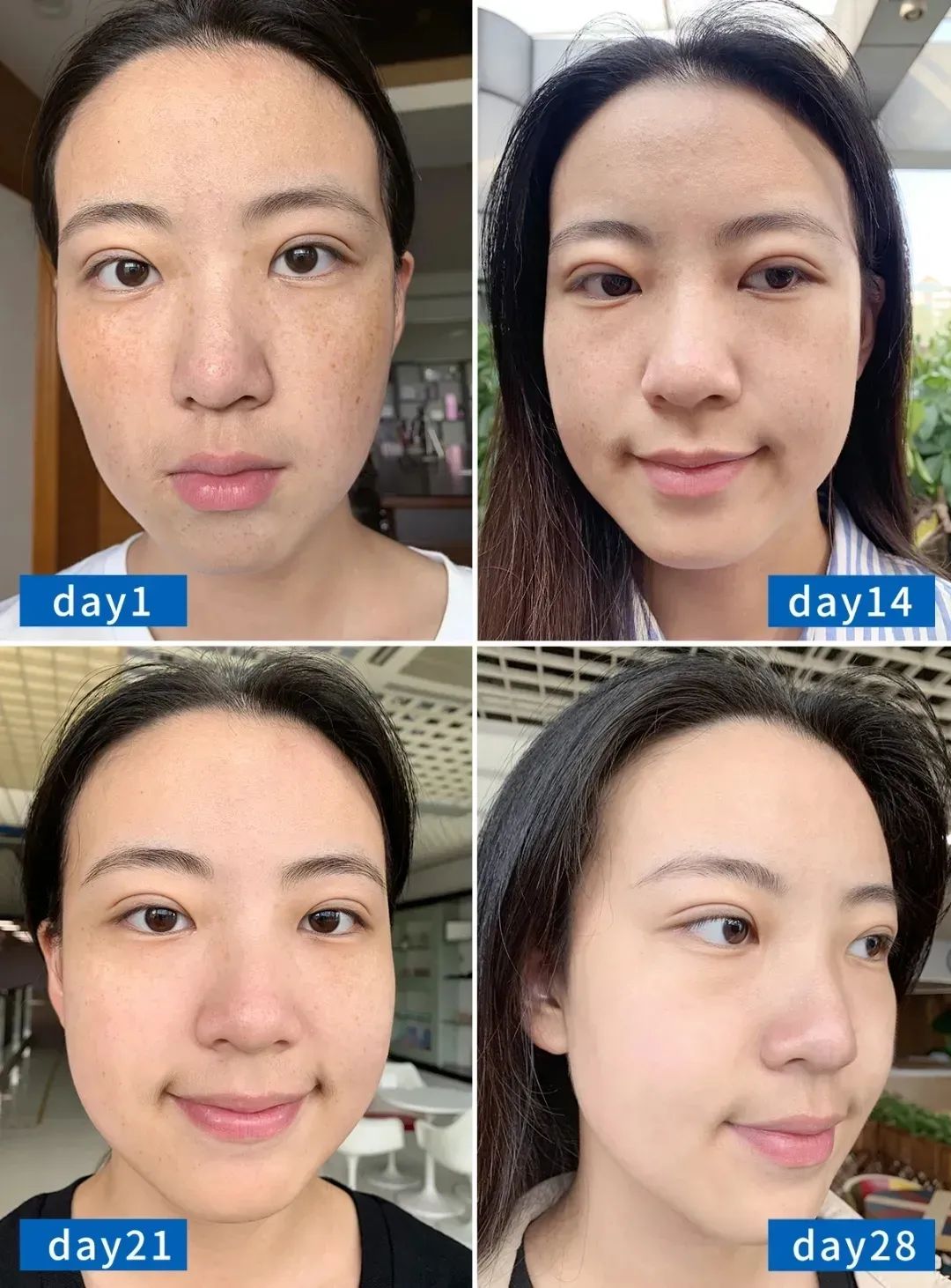 花了3万做激光,才彻底懂了:医生为什么劝你别去斑