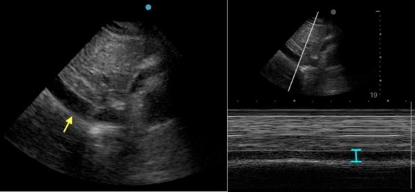 流感病毒会引起心脏问题吗,病毒引起的心脏罕见病