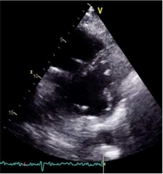 导管消融心衰病人做几次,心房颤动经导管射频消融并发症