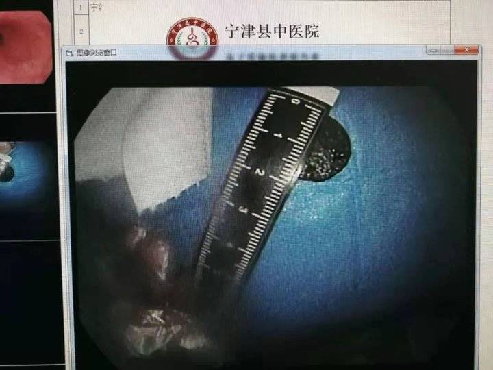 吉林一男子吃饺子误将硬币吞进肚,吃饺子吃到硬币把牙崩掉了一块