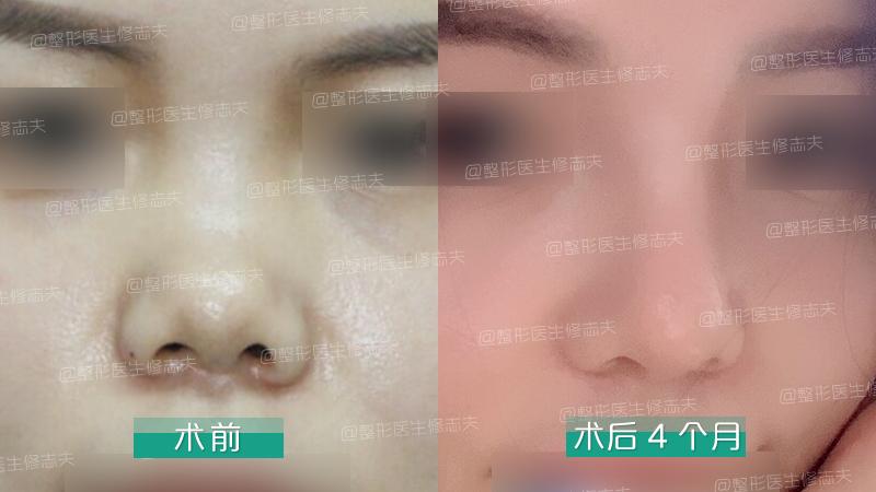 鼻综合整形切口,鼻综合切口处愈合几率