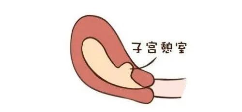 广州子宫疤痕憩室如何修复,瘢痕憩室引起妇科炎症怎么办