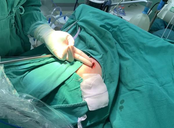 青少年有肺大泡怎么办,先天发育缺陷导致肺大泡