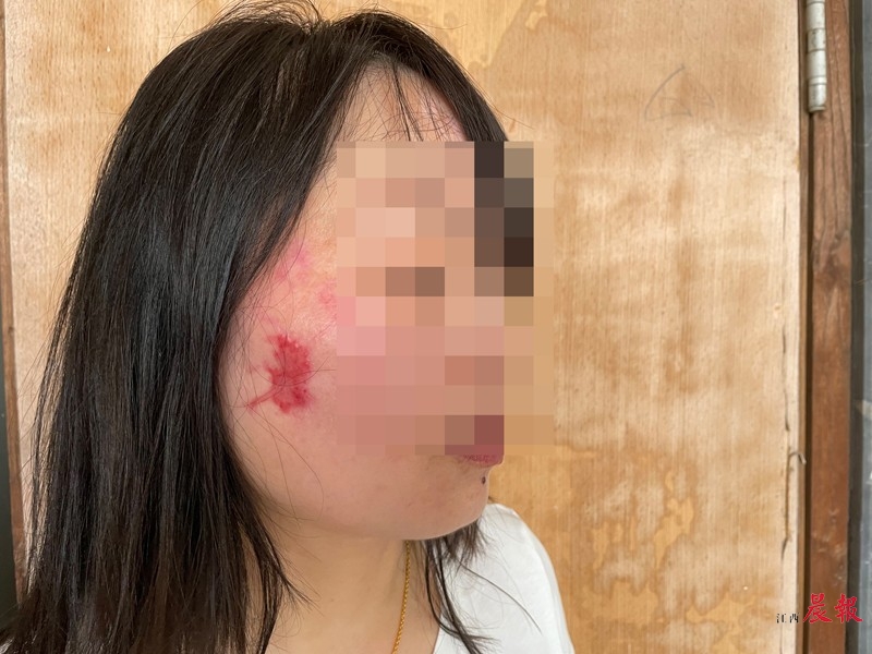 南昌女子花5000元祛疤美容后面目全非“美艺”新门店不认账