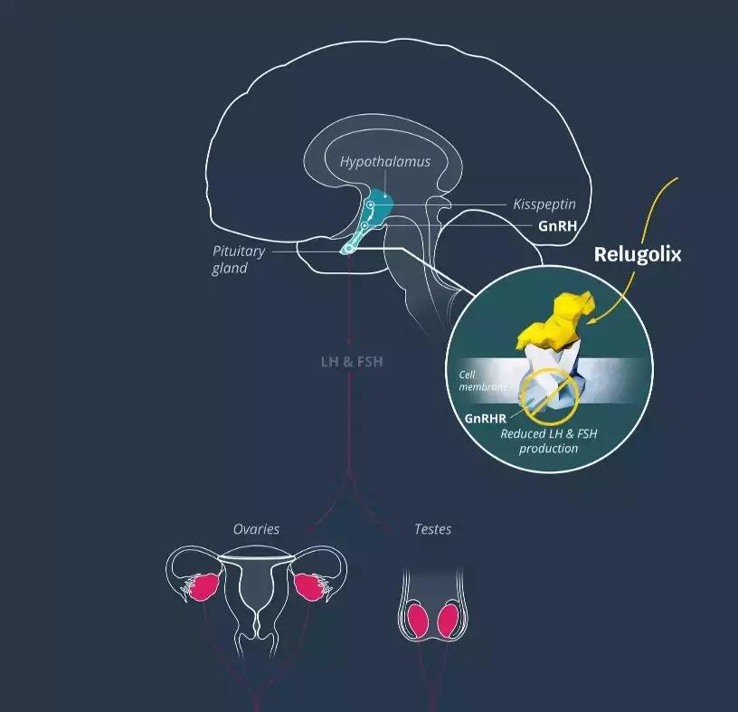 戈舍瑞林治疗子宫肌瘤,ve治疗子宫肌瘤