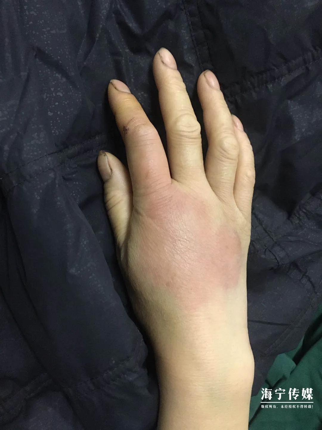 十大毒虫咬人后果,十大毒虫咬人了怎么办