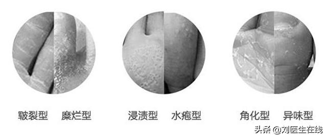 灰指甲怎么治好得最快小妙招,灰指甲怎么治才能彻底根除