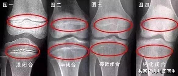 谁说身高都是父母遗传决定？医生：春天做好这4件事，一样能长高