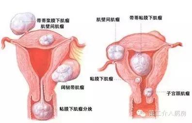 子宫肌瘤手术影响怀孕吗,子宫肌瘤一定要手术吗
