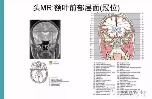 电子版头颅ct与mri断层解剖,头颅mri血管解剖与分段详解