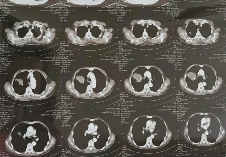 刘懿博士说肺癌（一二三九）肺上大瘤子近期又长了一厘米该不该治