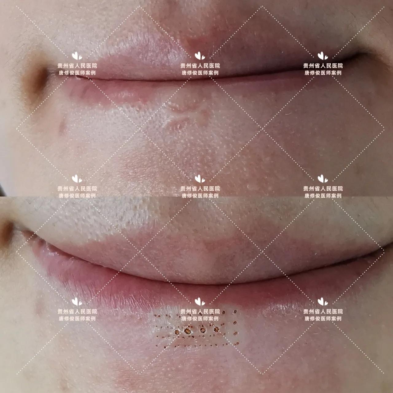 点阵激光祛疤痕增生会复发不,点阵激光治疗疤痕有效吗