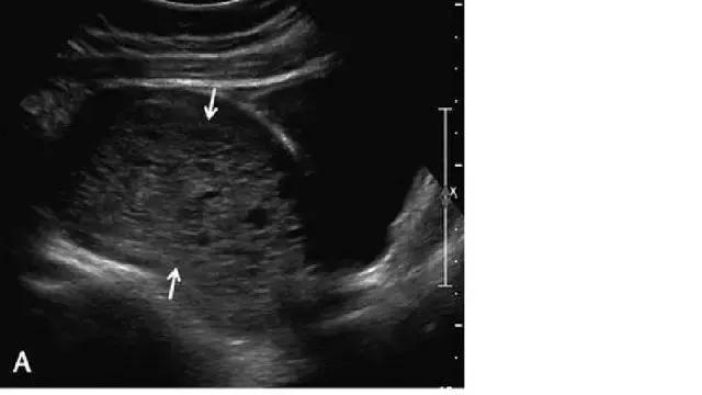 临床上最常见的异常胎盘,前置胎盘和低置胎盘超声