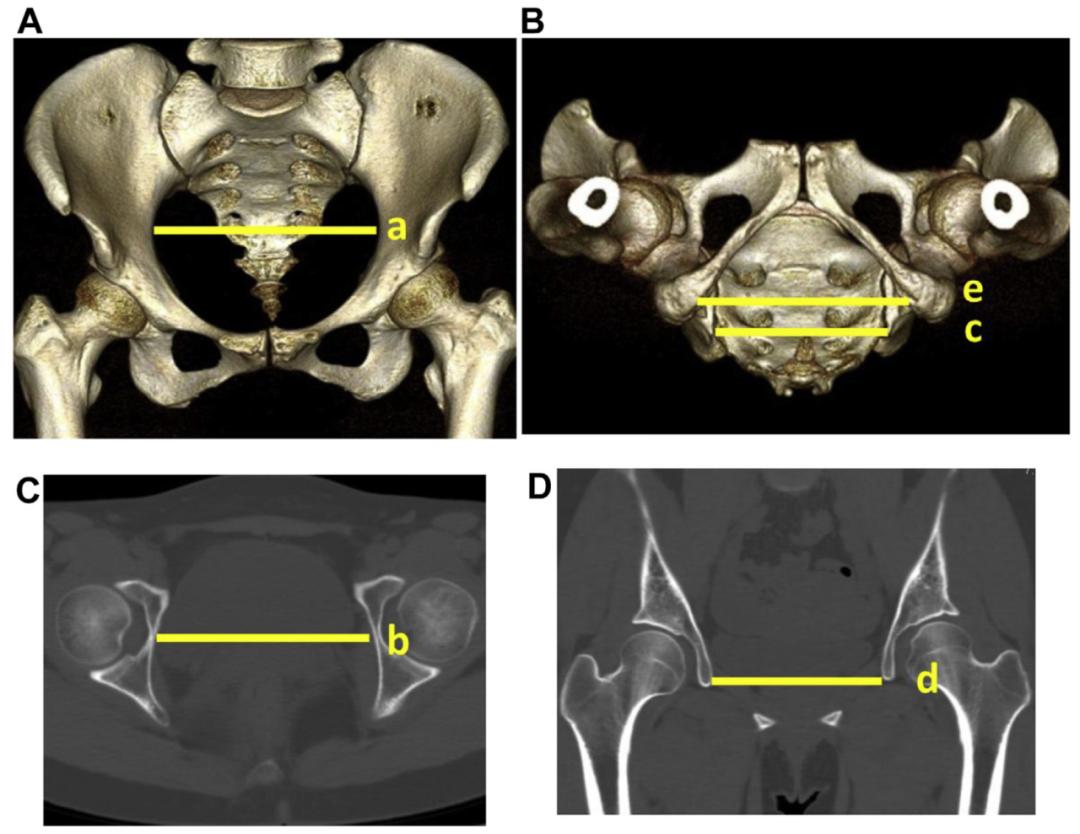 髋臼发育不良截骨的原理,髋臼截骨后会有长短腿吗