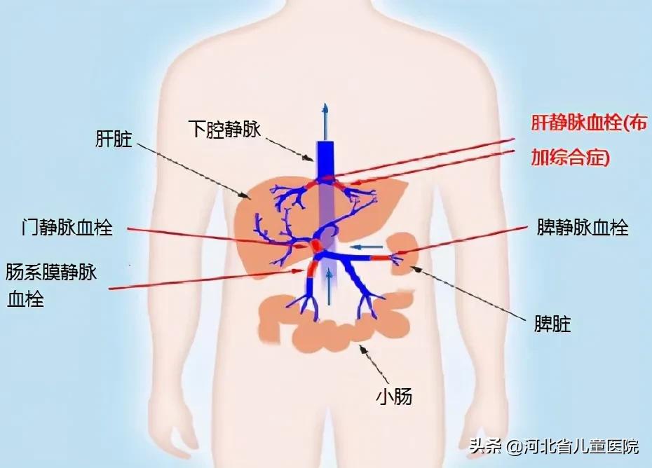 河北省儿童介入科,布加氏综合征介入手术