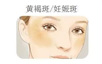 再美的脸,也抵挡不住“加斑”的困扰