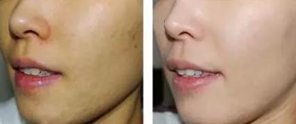 激光美白最真实的经历,激光美白为什么要一个月才有效果