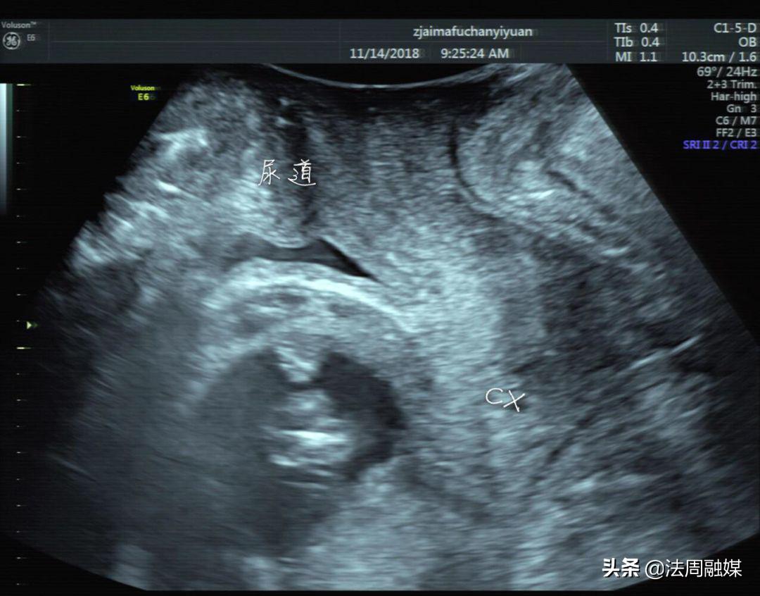 孕妇排尿困难怎么办最快最有效,孕妇小便难解是什么原因