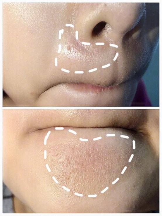 女生闭口痘痘怎么处理好得快,女生脸上有闭口痘痘怎么解决