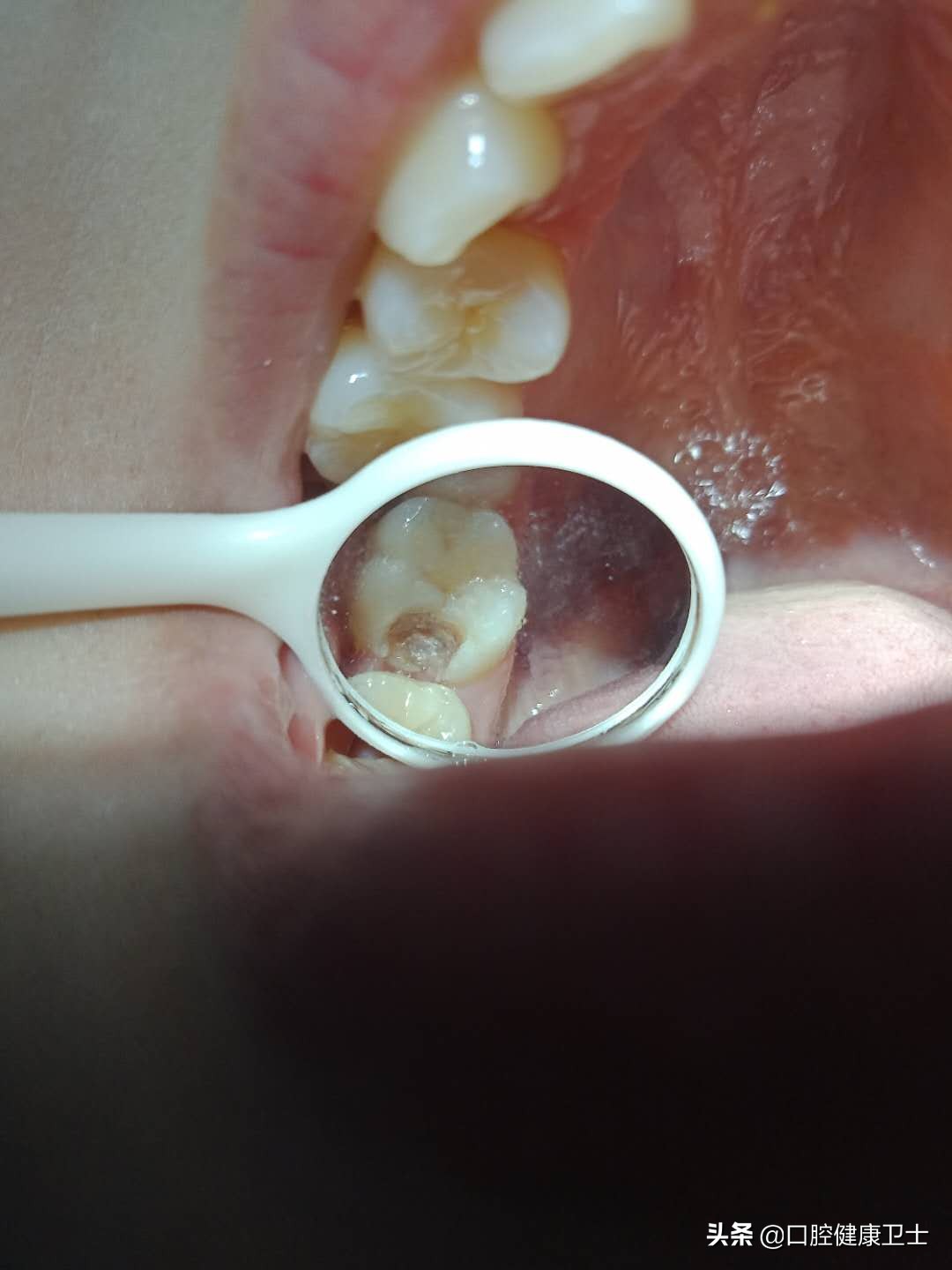 补牙后的牙缝越来越大怎么办,补牙之后牙缝塞东西导致牙龈痛