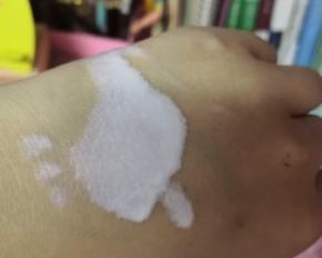 脸晒伤军训怎么防晒,什么防晒防止晒黑军训