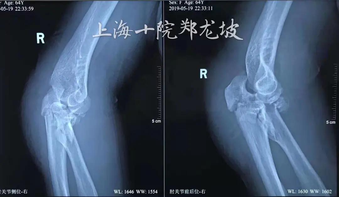 肘关节恐怖三联征康复训练图,肘关节恐怖三联征能彻底治愈吗