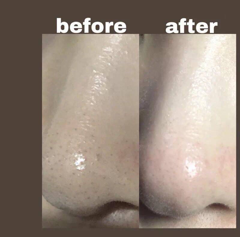 去黑头粉刺最好的建议,真正有效祛黑头粉刺