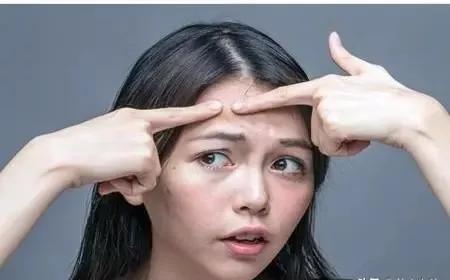 额头干鼻子出油长痘属于什么肌肤,女生额头长痘痘怎么办皮肤暗黄