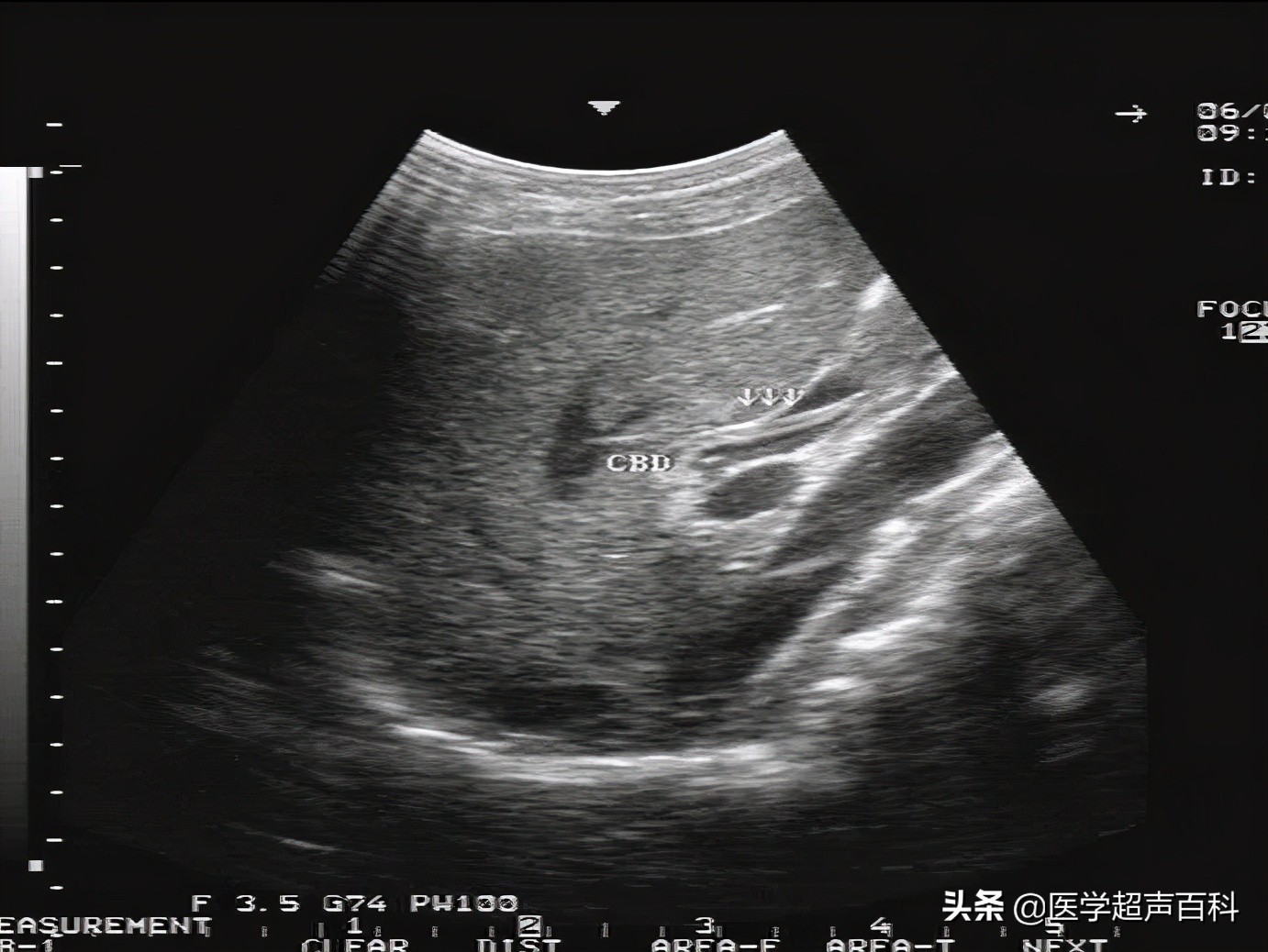 胆道蛔虫症的超声图像特征,超声蛔虫