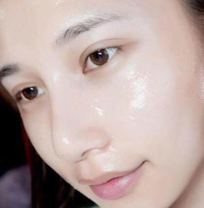 面部松弛怎么打玻尿酸,脸下垂用玻尿酸可以提升吗