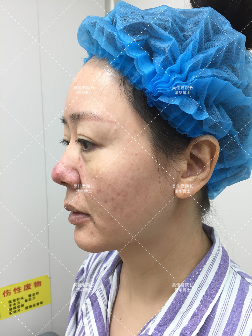 54岁姐姐分享大拉皮术后恢复历程,48岁做拉皮手术的真实经历