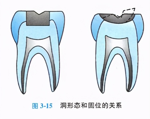 牙齿缺损修复去哪家牙科医院,牙科门牙缺损修复照片