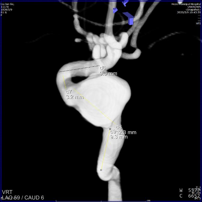 山东治脑动脉瘤最好的专家,菏泽市市立医院血管外科