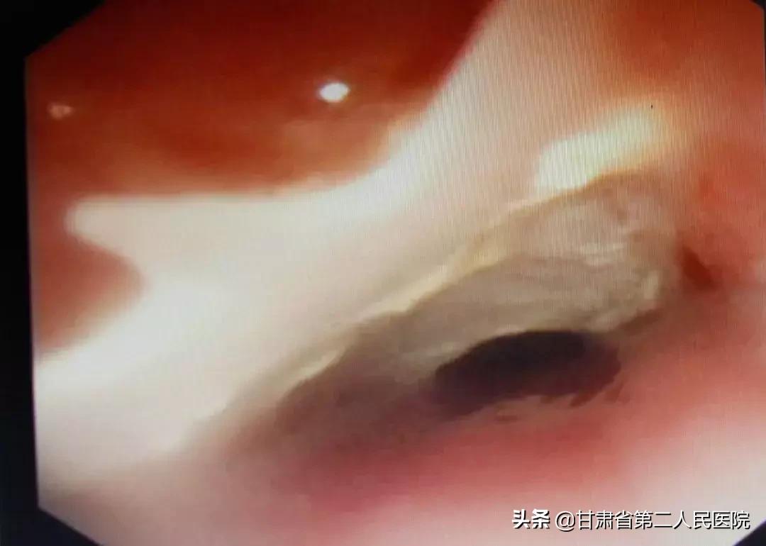 鱼骨刺卡喉咙最快的解决方法,鱼骨刺卡喉怎么办