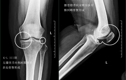 关节炎可以通过打抗生素治疗吗,关节炎治疗的注意事项