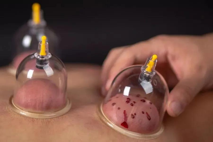 针灸治疗的效果令国外惊叹视频,贺氏针灸三通法怎么样