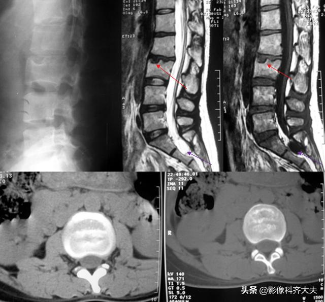 腰椎间盘突出的影像学诊断及治疗,腰椎间盘突出影像学课件
