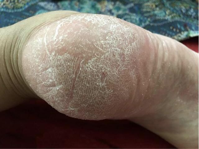 脚底有老皮老茧该用什么方法解决,脚上老是长厚厚的老茧怎么处理