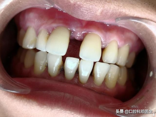 牙周炎引起门牙缝隙变大吗,牙周炎导致门牙往外突特别严重