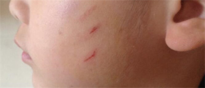 脸上外伤伤口怎么恢复最快不留疤,深伤口用什么处理伤口不易留疤