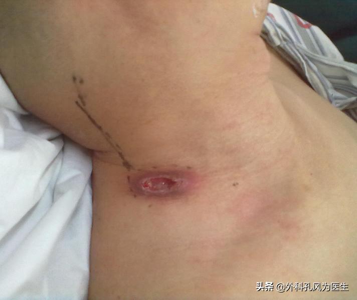 脖子上长疙瘩是什么肿瘤,脖子上有结核淋巴结是否有传染性