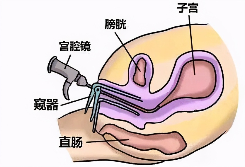 宫腔镜手术前需要做宫腔镜检查吗,试管婴儿前必须要做腹腔镜吗