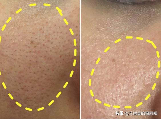 鸡皮肤怎么变白变嫩,如何去除鸡皮肤小窍门图解