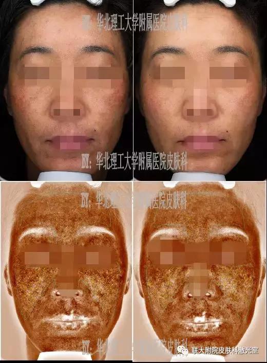 桃树褐斑穿孔病治疗方法,褐斑怎么治疗最有效