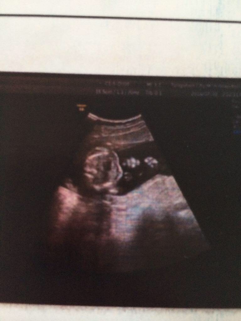 孕18周的胎儿是什么样子的,怀孕18周胎儿头围138mm正常吗