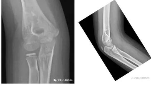 小孩手摔骨折打石膏后可以动吗,摔倒脚骨折需要打石膏吗