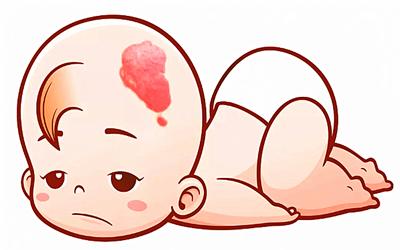 高频电凝微创术治疗血管瘤的危害,婴儿背部血管瘤不治疗有什么危害