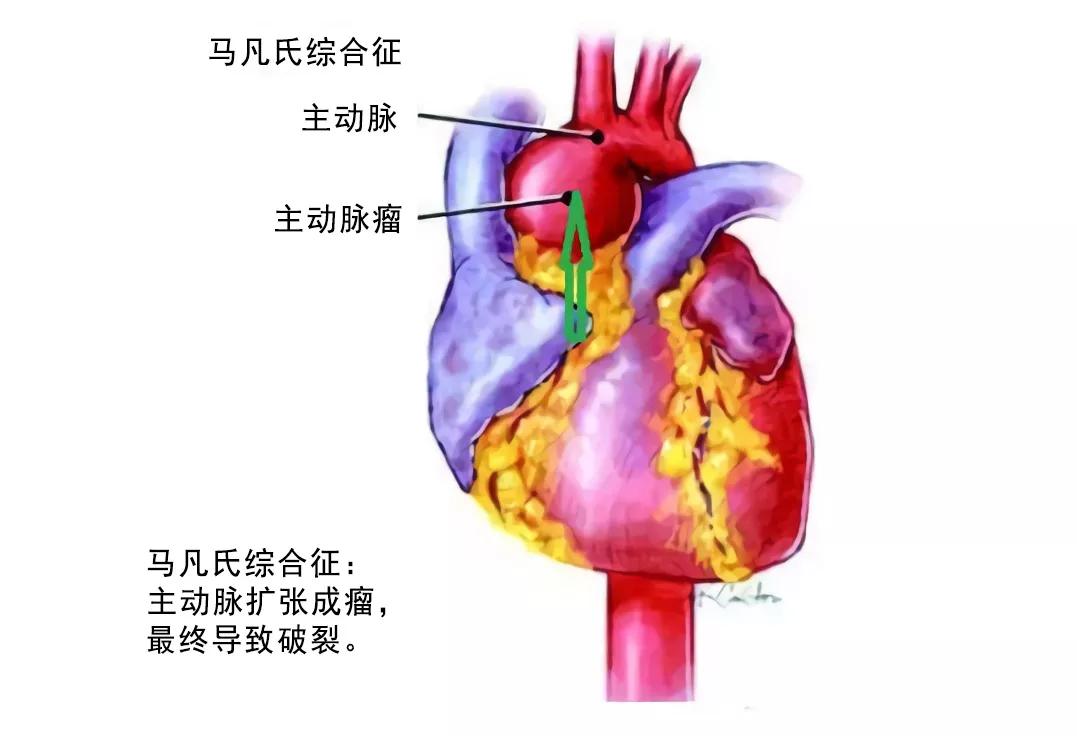 主动脉夹层需要和哪些疾病相鉴别,急性主动脉夹层是什么病怎么治
